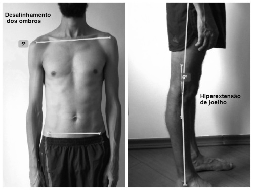 TeamFISIO - Fisioterapia - Avaliação Postural Computadorizada